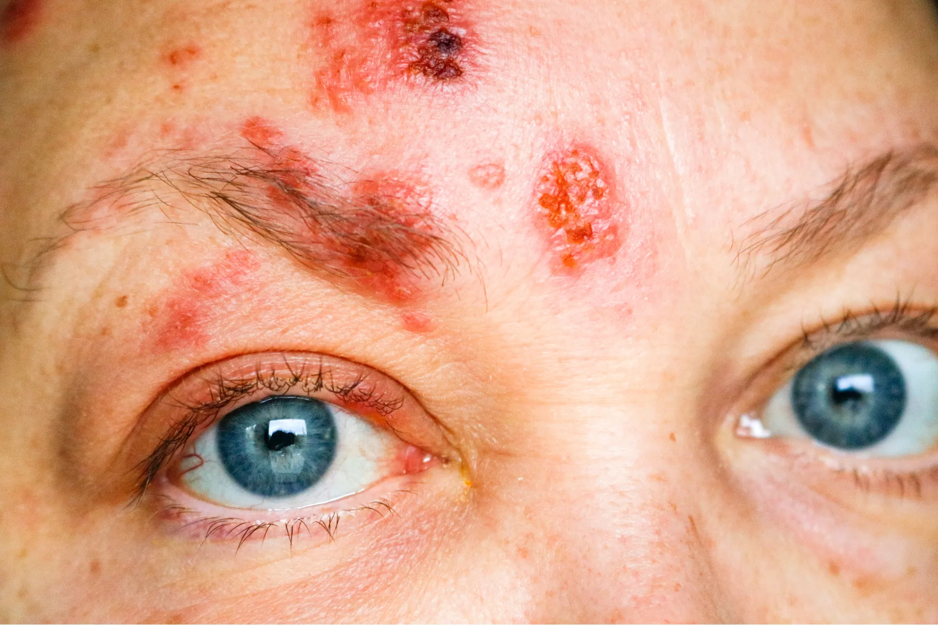 Complications of shingles?