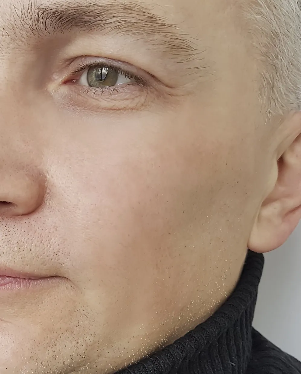 After Anti-wrinkle treatments After Anti-wrinkle treatments