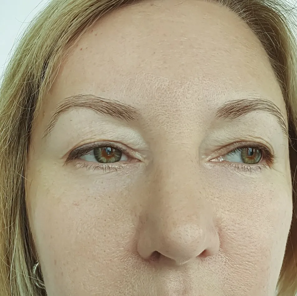 Filler treatments