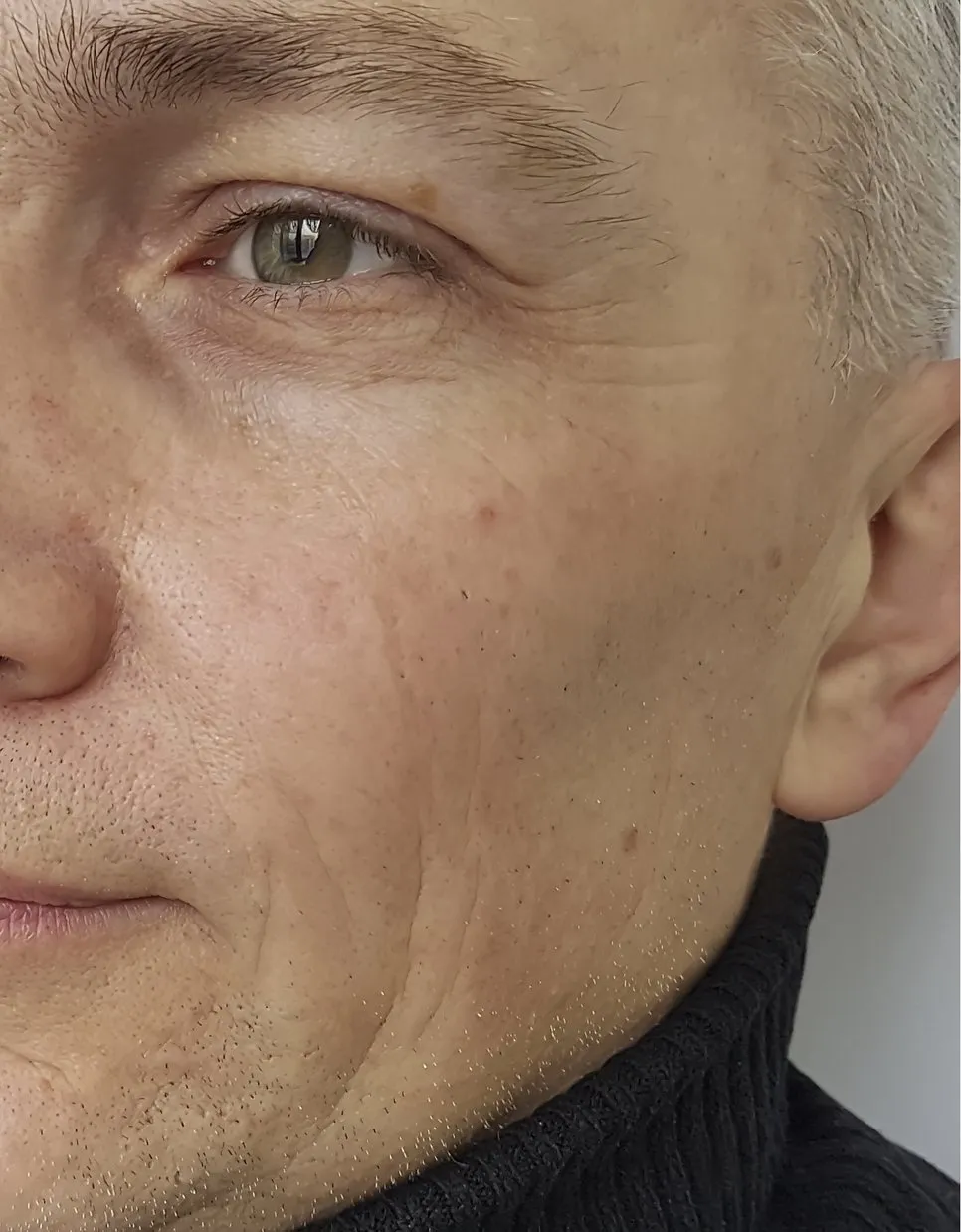 Before Anti-wrinkle treatments Before Anti-wrinkle treatments
