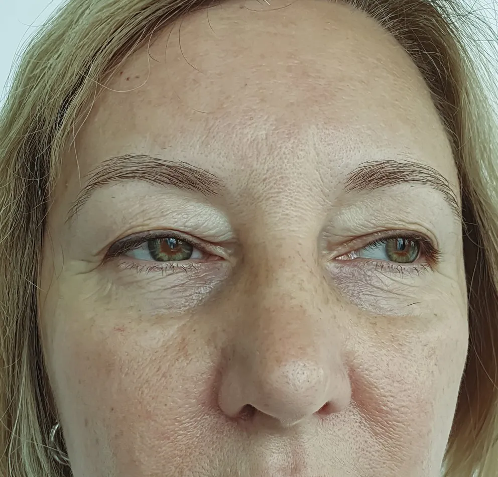 Filler treatments
