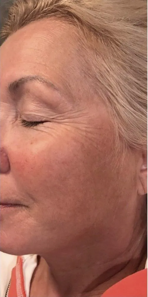 Chemical Peels